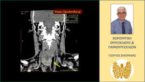 Καταδυόμενη βρογχοκήλη με πιεστικά φαινόμενα από την τραχεία – με αφορμή ασθενή μας (εικόνες) Καταδυόμενη βρογχοκήλη με πιεστικά φαινόμενα από την τραχεία – με αφορμή ασθενή μας (εικόνες)