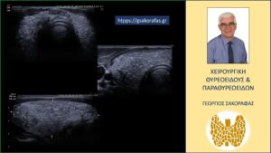 Επιθετικός καρκίνος θυρεοειδούς σε νεαρό ασθενή μας με προεγχειρητική διάγνωση παραπομπής «βρογχοκήλη» Χαρακτηριστικές εικόνες στο υπερηχογράφημα που υποδηλώνουν διάχυτη κατάληψη του θυρεοειδικού παρεγχύματος από πολυεστιακό καρκίνο θυρεοειδούς με εκτεταμένη ενδοθυρεοειδική διασπορά