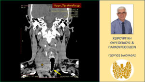 Καταδυόμενη βρογχοκήλη με πιεστικά φαινόμενα από την τραχεία – με αφορμή ασθενή μας (εικόνες) Ανάλογη εικόνα σε άλλο επίπεδο (κατά μέτωπο διατομή)