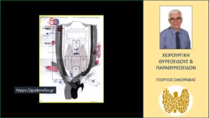 Επιθετικός καρκίνος θυρεοειδούς σε νεαρό ασθενή μας με προεγχειρητική διάγνωση παραπομπής «βρογχοκήλη» Η χειρόγραφη απόδοση της χαρτογράφησης λεμφαδένων τραχήλου