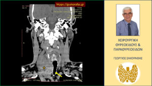 Καταδυόμενη βρογχοκήλη με πιεστικά φαινόμενα από την τραχεία – με αφορμή ασθενή μας (εικόνες) Εμφανής και σε αυτή τη διατομή η απώθηση της τραχείας προς τα αριστερά