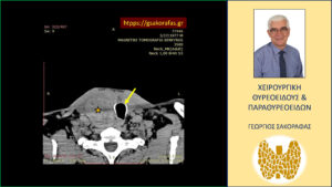 Καταδυόμενη βρογχοκήλη με πιεστικά φαινόμενα από την τραχεία – με αφορμή ασθενή μας (εικόνες) Στην εγκάρσια διατομή - ο διογκωμένος δεξιός λοβός (κίτρινος αστερίσκος) απωθεί προς τα αριστερά την τραχεία (κίτρινο βέλος).