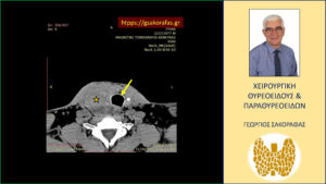 Καταδυόμενη βρογχοκήλη με πιεστικά φαινόμενα από την τραχεία – με αφορμή ασθενή μας (εικόνες) Ανάλογα ευρήματα σε άλλο επίπεδο (εγκάρσια διατομή)