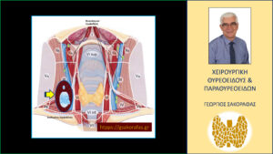 Κρύφιος καρκίνος θυρεοειδούς – με αφορμή ασθενή μας Κρύφιος καρκίνος θυρεοειδούς – με αφορμή ασθενή μας