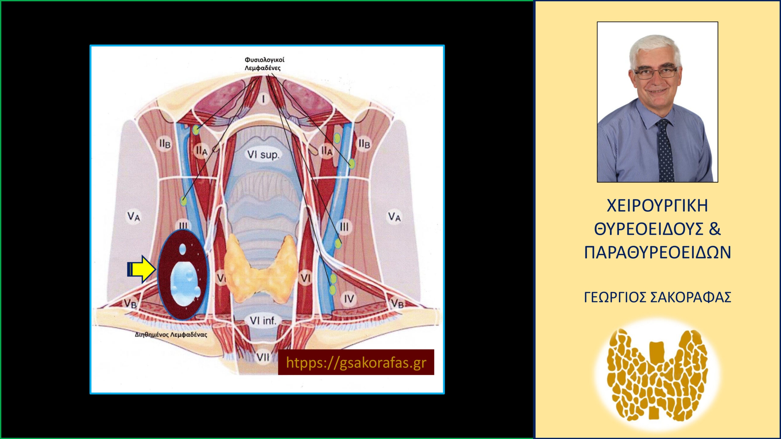 Κρύφιος καρκίνος θυρεοειδούς – με αφορμή ασθενή μας