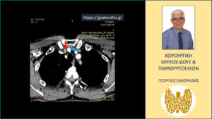 Έκτοπο αδένωμα παραθυρεοειδούς (κόκκινο βέλος) – σε ενδοθωρακική θέση (ανώτερο μεσοθωράκιο, επί τα εκτός της ανωνύμου αρτηρίας (μπλε βέλος). Εικόνα σε εγκάρσια διατομή στην τετραδιάστατη αξονική τομογραφία σε χαμηλότερο επίπεδο.