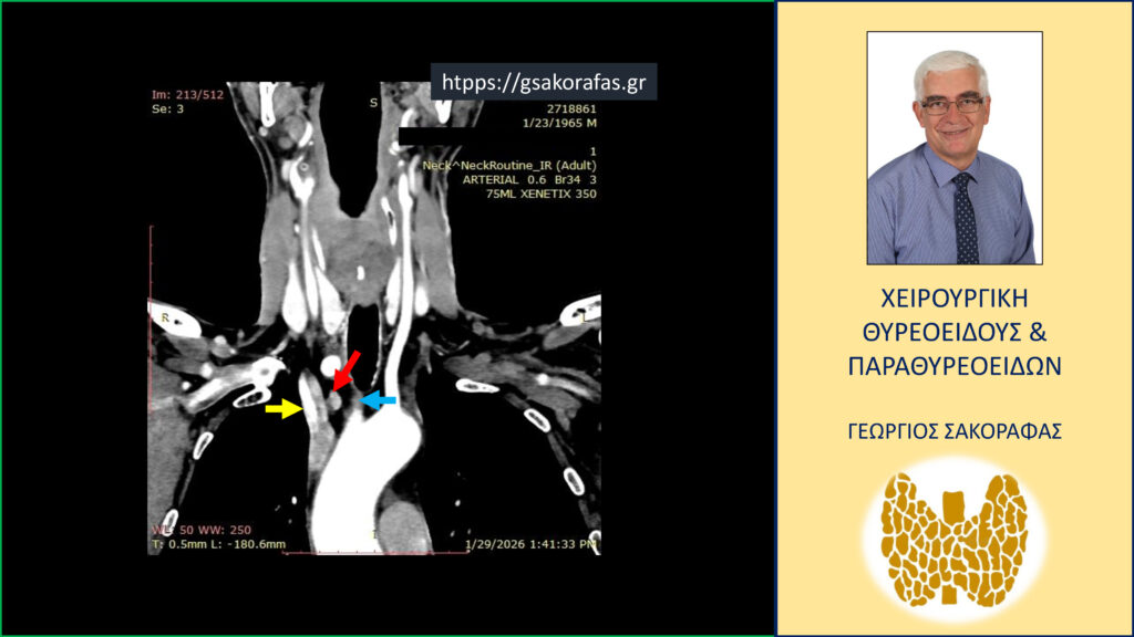 Home Έκτοπο αδένωμα παραθυρεοειδούς (κόκκινο βέλος) – σε ενδοθωρακική θέση (ανώτερο μεσοθωράκιο, μεταξύ της ανωνύμου αρτηρίας (μπλε βέλος) και της βραχιονοκεφαλικής φλέβας (κίτρινο βέλος). Εικόνα σε κατά μέτωπο διατομή στην τετραδιάστατη αξονική τομογραφία (σε άλλο επίπεδο σε σχέση με την προηγούμενη.