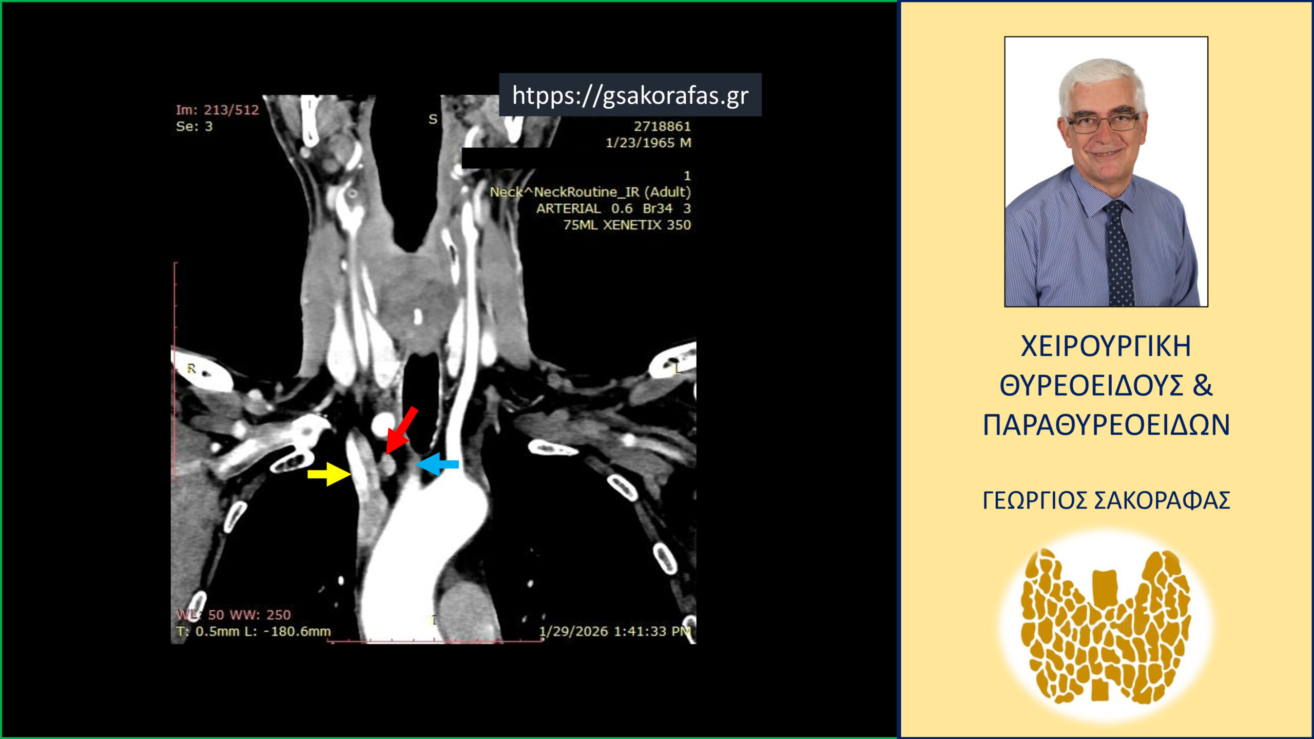 Έκτοπο αδένωμα παραθυρεοειδούς σε ενδοθωρακική θέση – αφαίρεση μέσω τραχηλικής τομής σε ασθενή με επιμένοντα πρωτοπαθή υπερπαραθυρεοειδισμό