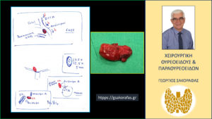 Έκτοπο αδένωμα παραθυρεοειδούς σε ενδοθωρακική θέση – αφαίρεση μέσω τραχηλικής τομής σε ασθενή με επιμένοντα πρωτοπαθή υπερπαραθυρεοειδισμό Σχηματική αναπαράσταση των δεδομένων της τετραδιάστατης αξονικής τομογραφίας για την διευκόλυνση της εξέλιξης της επέμβασης. Στο ένθετο δεξιά το έκτοπο ενδοθωρακικό αδένωμα μετά την εκτομή του.