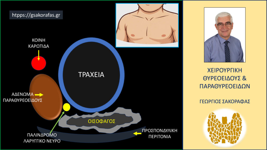 Home Ευμέγεθες αδένωμα παραθυρεοειδούς σε βαθιά προσπονδυλική θέση σε ασθενή μας (εικόνες)