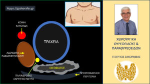 Σχηματική απεικόνιση των υπερηχογραφικών ευρημάτων με ακριβή εντοπισμό του λίαν ευμεγέθους αδενώματος παραθυρεοειδών