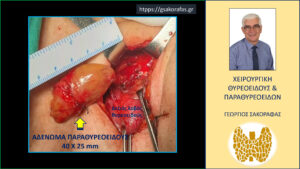 Ευμέγεθες αδένωμα παραθυρεοειδούς σε βαθιά προσπονδυλική θέση σε ασθενή μας (εικόνες)