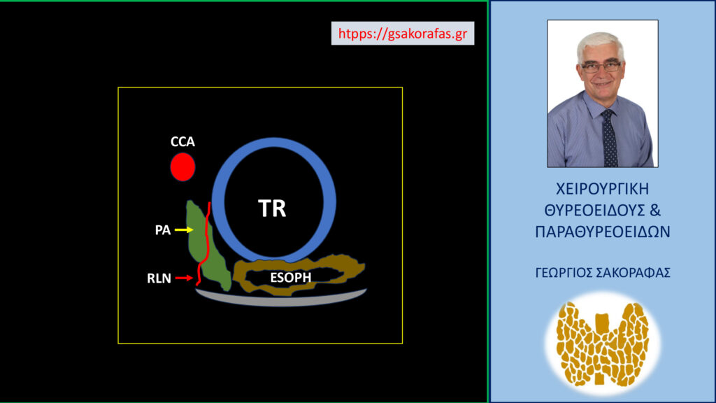 Home Αδένωμα παραθυρεοειδούς, έκτοπο, βαθύ, οπισθοκαρωτιδικό – με αφορμή ασθενή μας