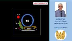 Αδένωμα παραθυρεοειδούς, έκτοπο, βαθύ, οπισθοκαρωτιδικό – με αφορμή ασθενή μας