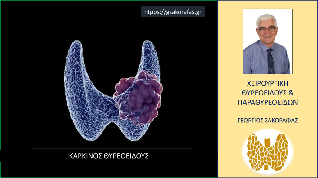 Home Καρκίνος θυρεοειδούς – σημαντικά βήματα για την επιτυχή του αντιμετώπιση