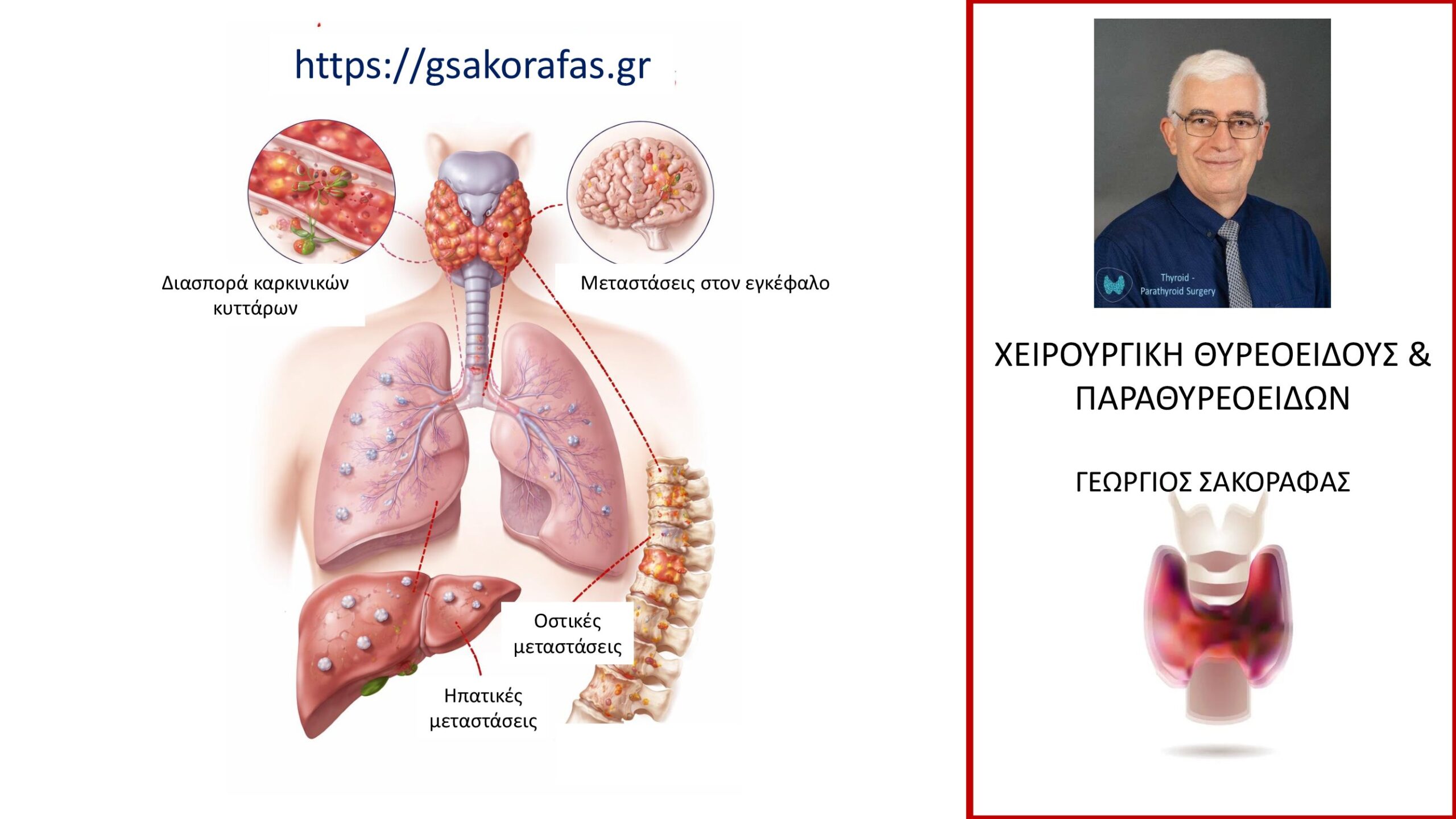 Καρκίνος θυρεοειδούς και μεταστάσεις σε μακρινά όργανα (μακρινές μεταστάσεις) – τι προβλήματα μπορεί να δημιουργήσουν?