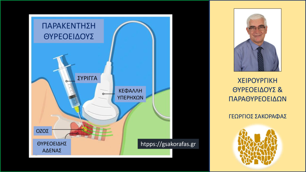 Home Παρακέντηση θυρεοειδούς – τί είναι, πότε και πώς γίνεται και τι σημασία έχει στην πράξη?