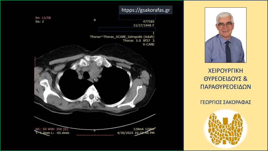 Home Καταδυόμενος όζος θυρεοειδούς σε υπερήλικα ασθενή - εικόνες