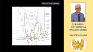 Όζος θυρεοειδούς καταδυόμενος σε υπερήλικα ασθενή - εικόνες Υπερηχογραφική εικόνα