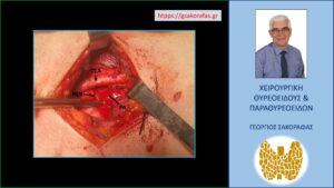 Ευρήματα στη διάρκεια της χειρουργικής επέμβασης