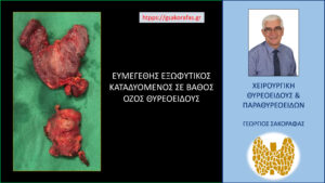 Έκτοπος θυρεοειδής (παθολογικός, ενδοθωρακικός όζος) σε ασθενή μας – εικόνες Χειρουργικό παρασκεύασμα. Ο έκτοπος καταδυόμενος θυρεοειδικός ιστός έχει περίπου το μέγεθος ενός λοβού θυρεοειδούς. Δεν είχε εμφανή συνέχεια με το λοιπό θυρεοειδικό παρέγχυμα, πράγμα που δικαιολογεί τον χαρακτηρισμό του ως «έκτοπος θυρεοειδικός ιστός».