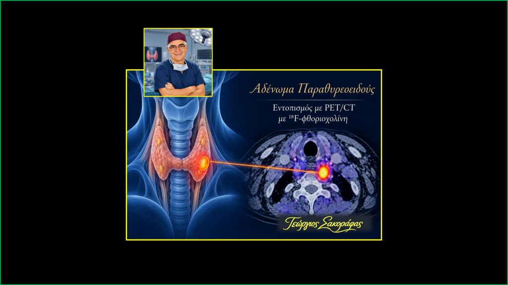 Home Αδένωμα Παραθυρεοειδούς Και Pet/Ct Με 18F-Φθοριοχολίνη